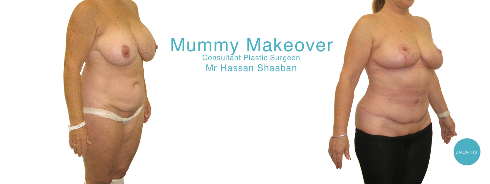 mummy makeover before and after surgery 